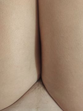 Aledema